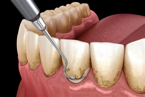 Periodoncia .